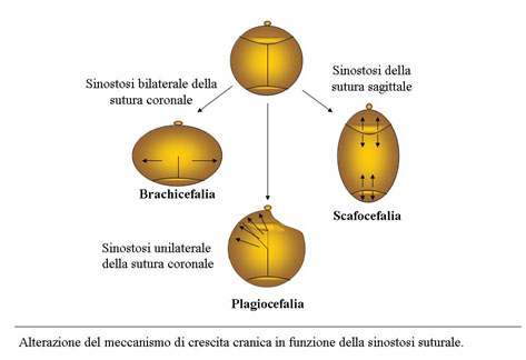 cranosteniosi